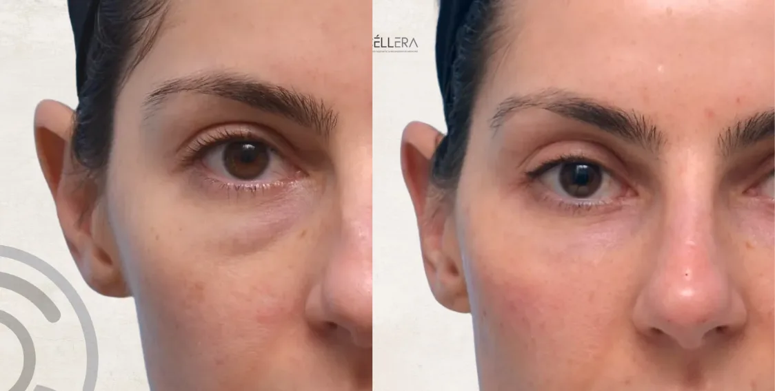 Fillers Pómulos